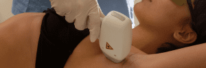 Epilazione laser dell'ascella con manipolo a contatto sulla pelle, paziente con occhiali di protezione