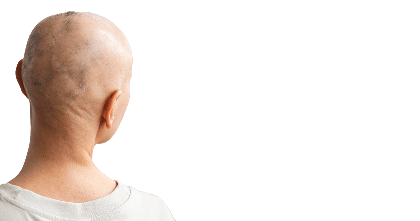 Alopecia