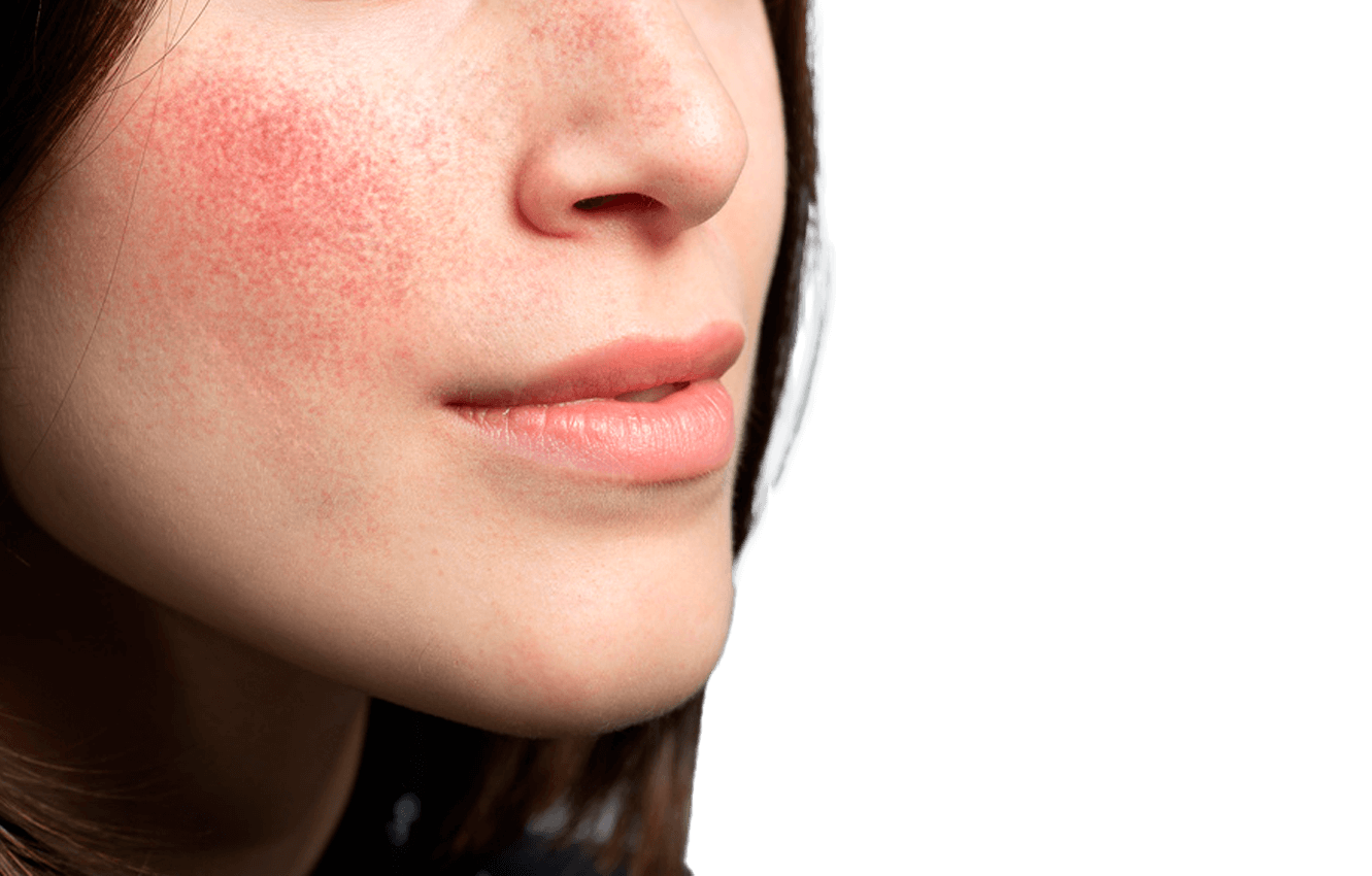 Rosacea