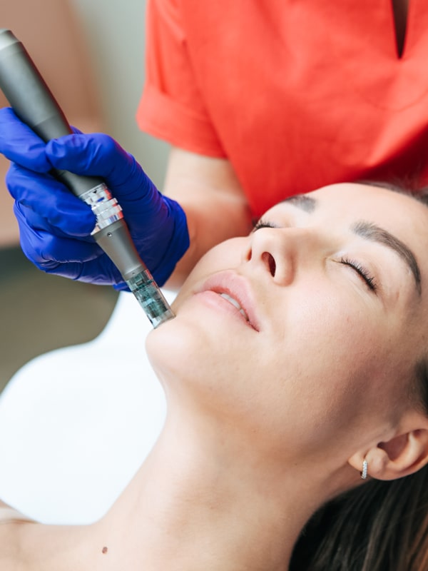 Microneedling