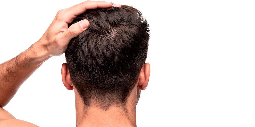 MMP – Micorinfusione di Farmaci nel Cuio Capelluto